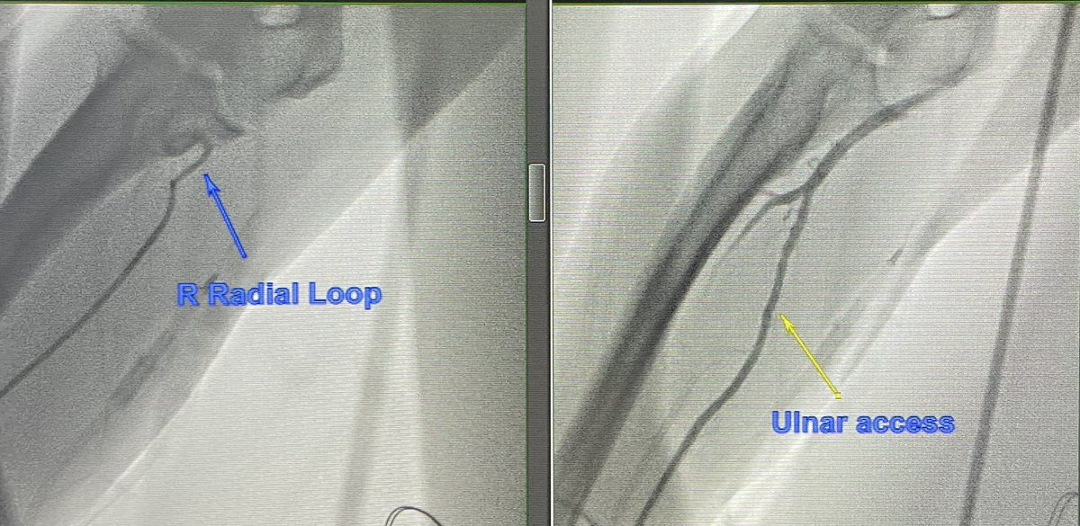 Updock's tweet photo. #Radialfirst people. You find yourself faced w a radial loop you cannot traverse. How often do you access ipsilateral #ulnarsecond ? https://t.co/KyPCvqVR6W