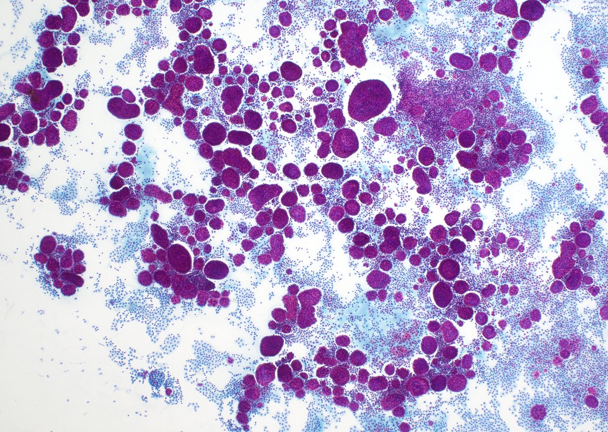 cjvand's tweet photo. Pleural effusion. Loss of BAP-1 nuclear expression in a mesothelioma. #cytopath #cytology https://t.co/URh2m6dgPm