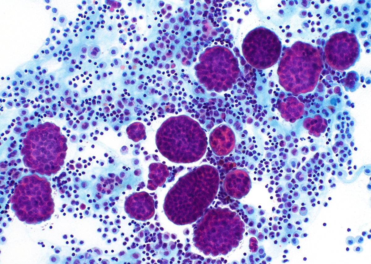 cjvand's tweet photo. Pleural effusion. Loss of BAP-1 nuclear expression in a mesothelioma. #cytopath #cytology https://t.co/URh2m6dgPm