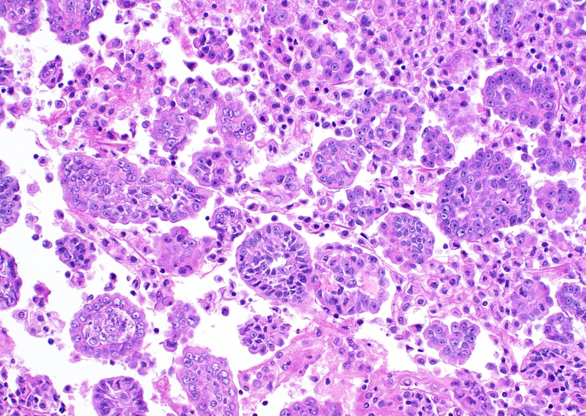 cjvand's tweet photo. Pleural effusion. Loss of BAP-1 nuclear expression in a mesothelioma. #cytopath #cytology https://t.co/URh2m6dgPm
