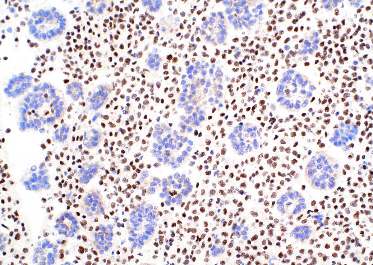 cjvand's tweet photo. Pleural effusion. Loss of BAP-1 nuclear expression in a mesothelioma. #cytopath #cytology https://t.co/URh2m6dgPm