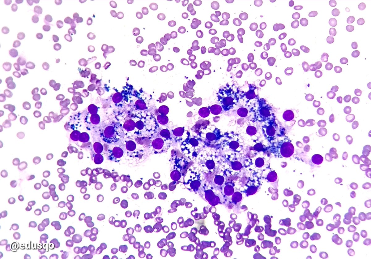 edusqo's tweet photo. Cytoplasmic granules represent lipofuscin or hemosiderin, it is nonspecific, but commonly seen in adenomatoid nodules with cystic changes and hemorrhage.
Be careful, review nuclear features, as always in thyroid 👀
Golden-brown (H&E) or blue (#DiffQuik)
#FNAFriday #EndoPath https://t.co/McO8yf8eLa