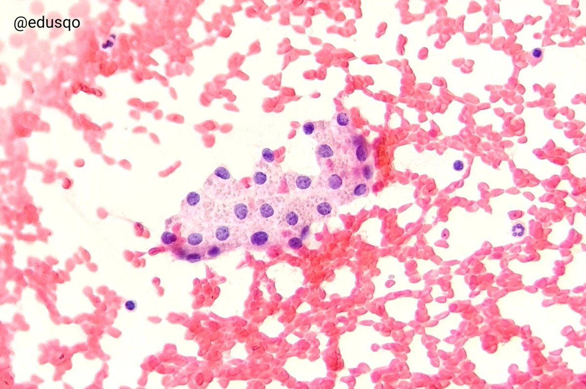 edusqo's tweet photo. Cytoplasmic granules represent lipofuscin or hemosiderin, it is nonspecific, but commonly seen in adenomatoid nodules with cystic changes and hemorrhage.
Be careful, review nuclear features, as always in thyroid 👀
Golden-brown (H&E) or blue (#DiffQuik)
#FNAFriday #EndoPath https://t.co/McO8yf8eLa