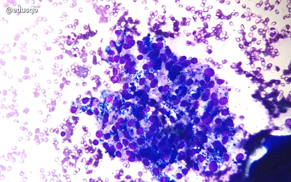 edusqo's tweet photo. Cytoplasmic granules represent lipofuscin or hemosiderin, it is nonspecific, but commonly seen in adenomatoid nodules with cystic changes and hemorrhage.
Be careful, review nuclear features, as always in thyroid 👀
Golden-brown (H&E) or blue (#DiffQuik)
#FNAFriday #EndoPath https://t.co/McO8yf8eLa