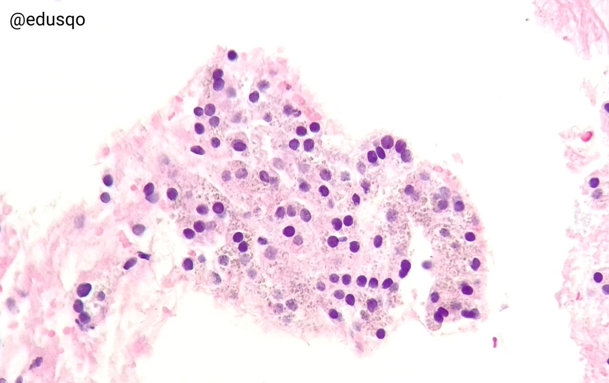 edusqo's tweet photo. Cytoplasmic granules represent lipofuscin or hemosiderin, it is nonspecific, but commonly seen in adenomatoid nodules with cystic changes and hemorrhage.
Be careful, review nuclear features, as always in thyroid 👀
Golden-brown (H&E) or blue (#DiffQuik)
#FNAFriday #EndoPath https://t.co/McO8yf8eLa