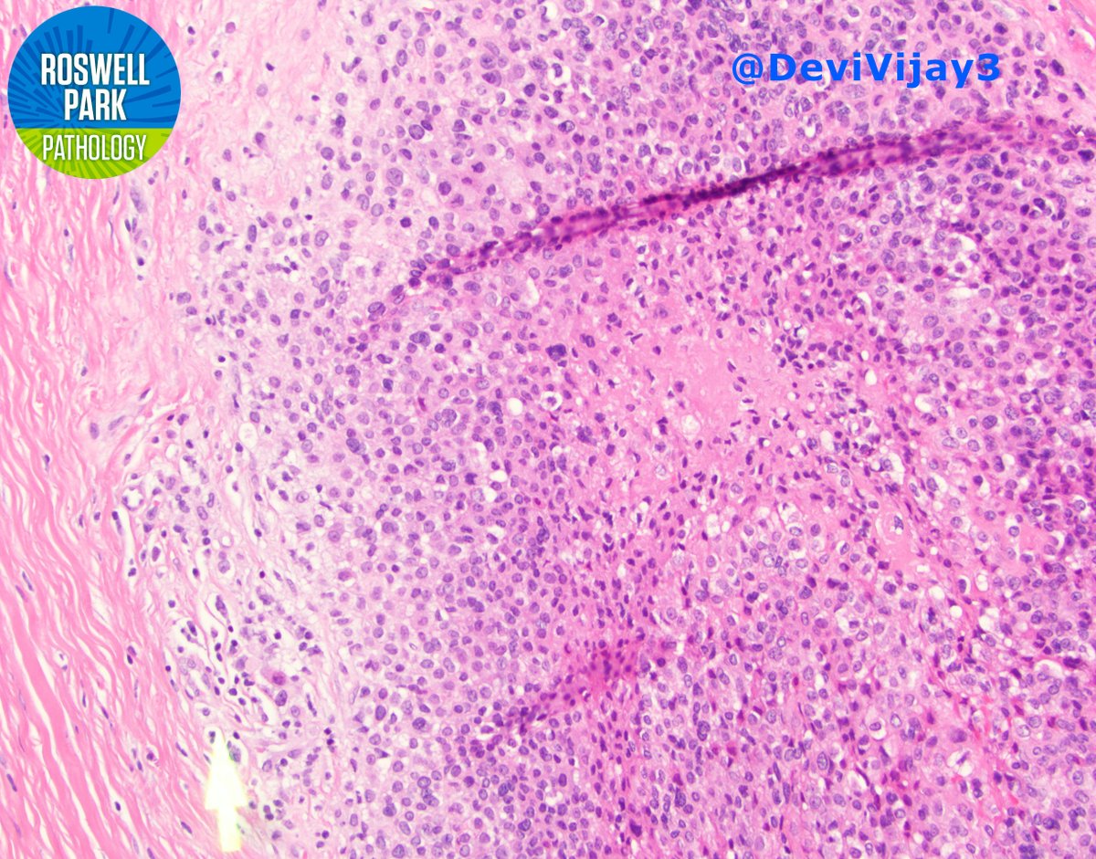 RoswellParkPath's tweet photo. Friday evening #GYNpath case 🙃

40 year old vulva mass resection 

What is your differential? What stains would you order? 

#pathology #pathresidents https://t.co/8uHQZkx75X