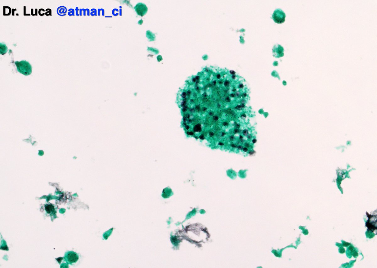 atman_ci's tweet photo. It's him! Pneumocystis Jirovecii a yeast-like fungus which infected an immunocompromised patient. Here for you a nice Grocott stain @msw_md @LoboAnandi @maldovi @pembeoltulu @vij_mukul @kriyer68 @DrGeeONE @mdlozanoe @EmilianPath #PathTwitter #CytoPath #Pathbugs #crittersontwitter https://t.co/LAZbkQakGs