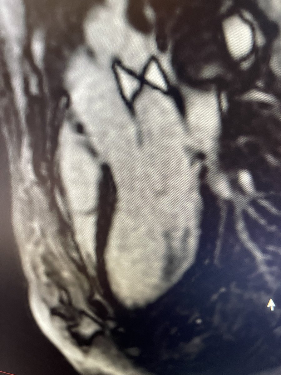 At our institution we insist that the left atrium wears a bowtie