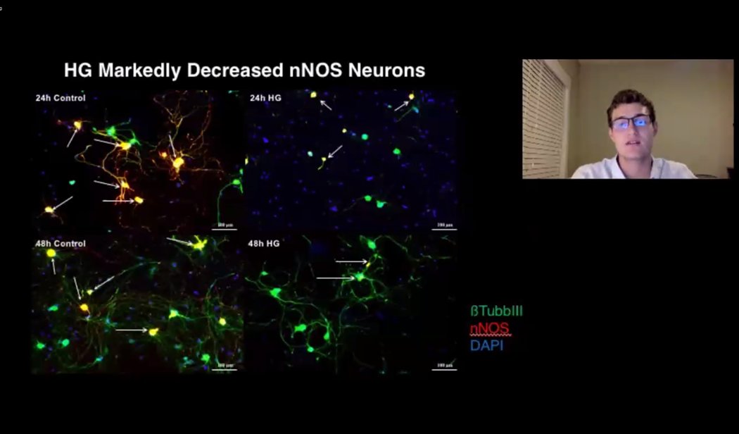 Dr Johanna Hannan (@hannan_lab) on Twitter photo We all remember our first scientific presentation😱Masters #gradstudent <a href="/PallasWrenn/">Wrenn Pallas</a> did great with his first at the 9th International Urogenital Science Virtual Meeting! He was 1 of 5 selected to represent <a href="/Soc4PelvicRes/">Society for Pelvic Research</a> at this meeting. <a href="/ECUResearch/">ECU Research</a> <a href="/ECUBrodySOM/">ECU Brody School of Medicine</a> <a href="/ECUGradSchool/">East Carolina University Graduate School</a> We all remember our first scientific presentation😱Masters #gradstudent <a href="/PallasWrenn/">Wrenn Pallas</a> did great with his first at the 9th International Urogenital Science Virtual Meeting! He was 1 of 5 selected to represent <a href="/Soc4PelvicRes/">Society for Pelvic Research</a> at this meeting. <a href="/ECUResearch/">ECU Research</a> <a href="/ECUBrodySOM/">ECU Brody School of Medicine</a> <a href="/ECUGradSchool/">East Carolina University Graduate School</a>