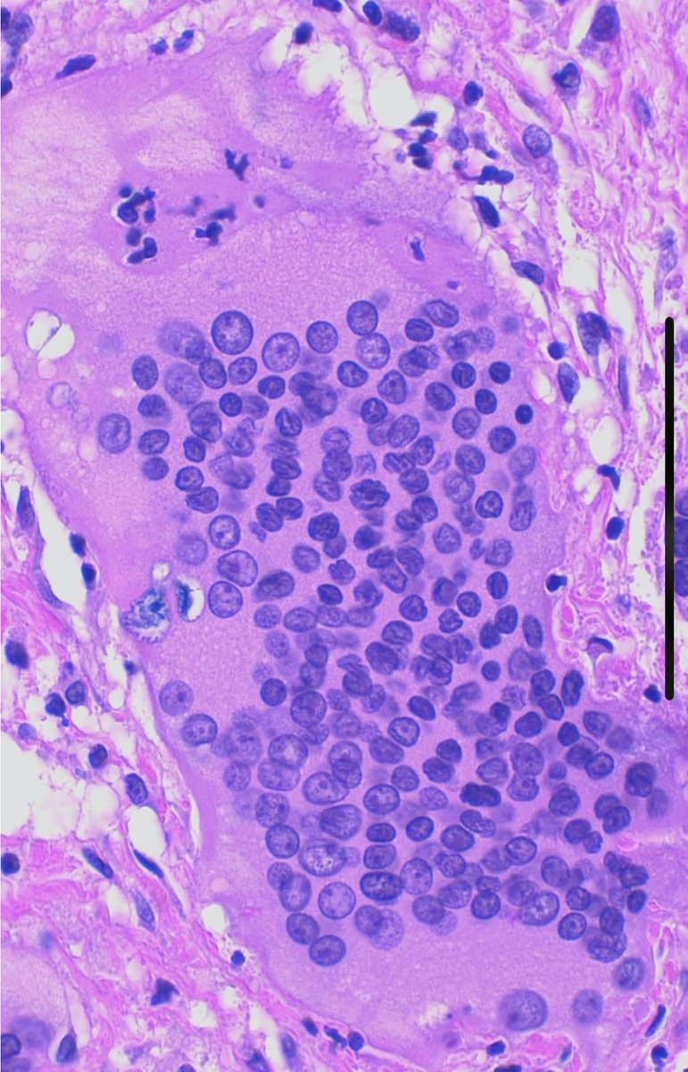 JCandidoXavier's tweet photo. Today I have introduced the #pathology concepts of multinucleated giant cell and granulomatous inflammation to my #medstudents 

#MedTwitter #patología #PathTwitter #path #patologia #pathclues https://t.co/mWLyEriOZg