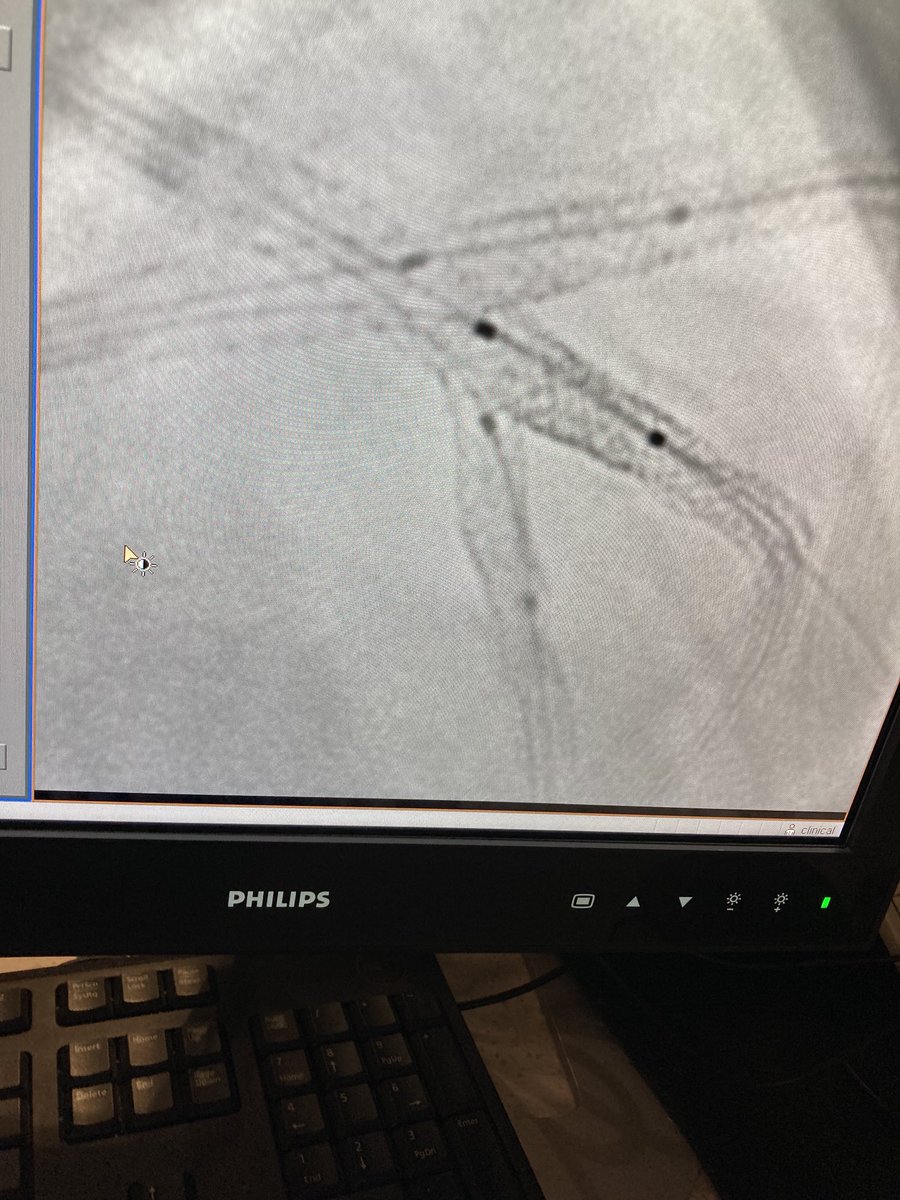 Brian Bergmark (@brianbergmark) on Twitter photo classic starfish trifurcation pci <a href="/kevinjamescroce/">Kevin Croce MD, PhD</a> <a href="/Ajar_Kochar/">Ajar Kochar</a> <a href="/lindsey_cilia/">Lindsey Cilia</a> <a href="/MusaSharkawiMD/">Musa A. Sharkawi</a> <a href="/RWatsonMD/">Ryan Watson</a> <a href="/PinakShahMD/">Pinak Shah, MD</a> classic starfish trifurcation pci <a href="/kevinjamescroce/">Kevin Croce MD, PhD</a> <a href="/Ajar_Kochar/">Ajar Kochar</a> <a href="/lindsey_cilia/">Lindsey Cilia</a> <a href="/MusaSharkawiMD/">Musa A. Sharkawi</a> <a href="/RWatsonMD/">Ryan Watson</a> <a href="/PinakShahMD/">Pinak Shah, MD</a>