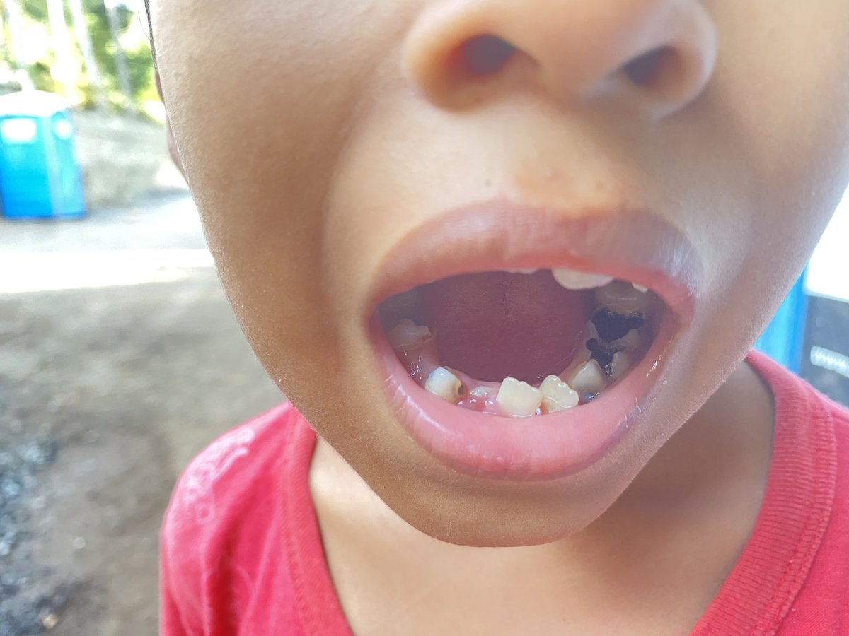 SusieBdds's tweet photo. Dentisting around @Bitcoinbeach doing exams today and the needs are overwhelming. Young, single mothers with horrible toothaches, children with a mouth full of bombed out teeth sipping on sodas. 

My purpose is found and intention is set. #Bitcoin has allowed me to do this.🧡 https://t.co/0WCGskFQpN
