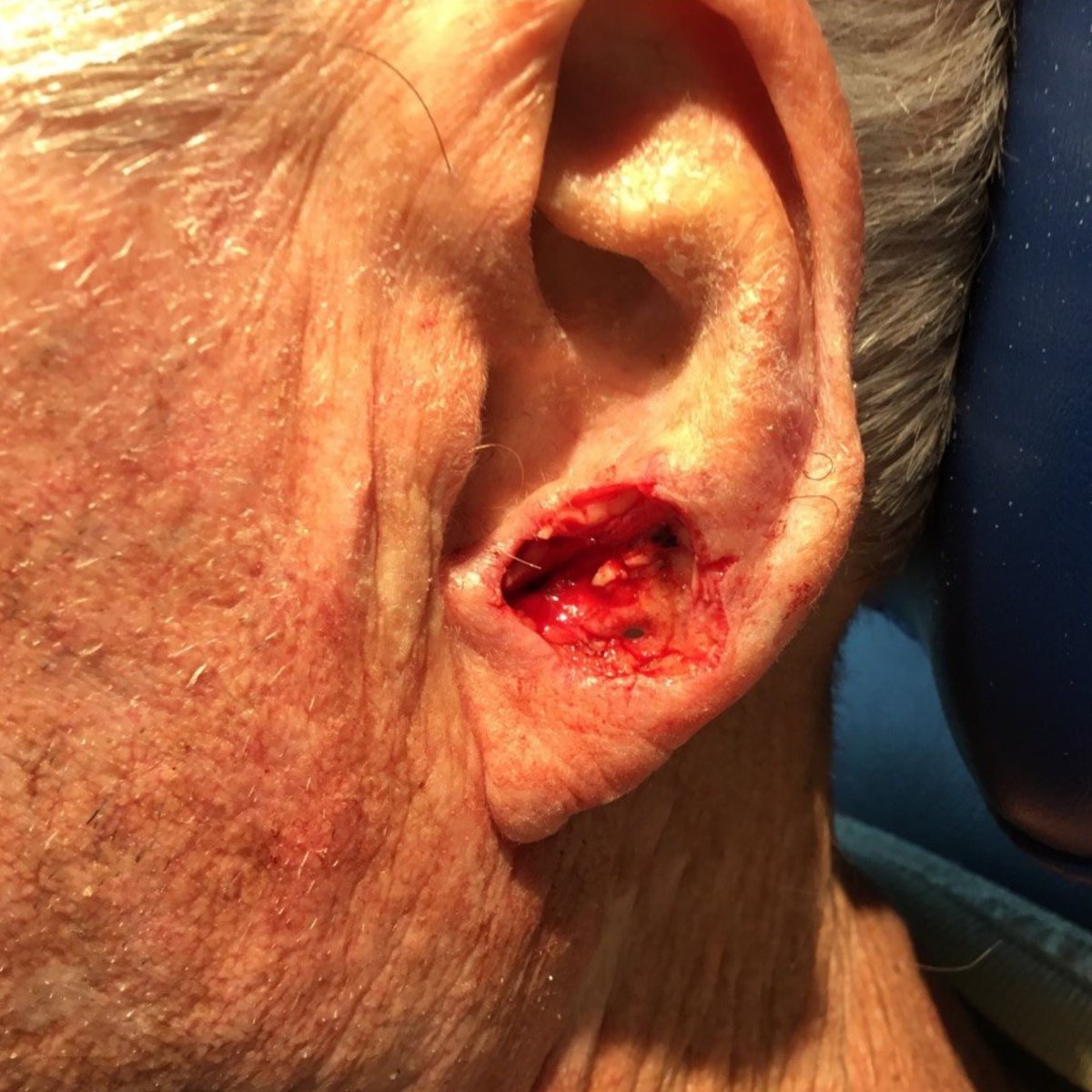 MohsCollege's tweet photo. #FlapFriday This patient underwent Mohs surgery for a Squamous cell carcinoma of the antitragus and earlobe, resulting in exposed cartilage, a loose free margin and very focal full thickness defect. https://t.co/hZlHWSzw3r