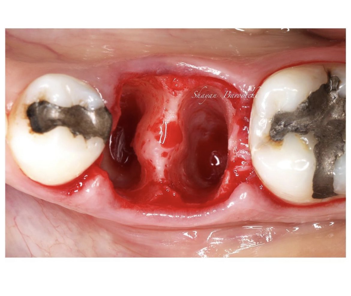 dentiscope's tweet photo. Immediate implant therapy for a molar site with simultaneous hard &amp; soft tissue grafting using a Cross-linked Xenogeneic Collagen Matrix #fibrogide 

Note the buccal plate and thin soft tissues in the cross-sectional image of the ultrasound scan. https://t.co/oCyHApNYbR