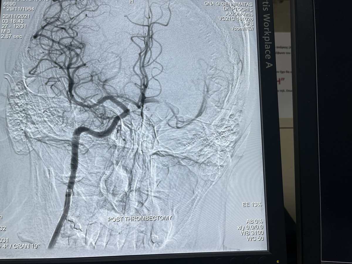 One more Stroke patient was successfully treated!
#InterventionalRadiology #irad #stroke #Neurology #thrombectomy #clinicalIR