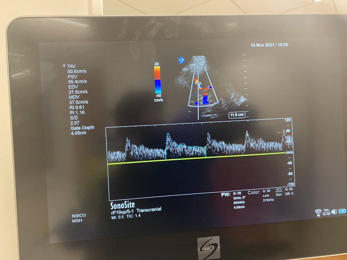 collinflan's tweet photo. Internal Reflections or: proof my skull is not as thick as previously believed #neurocrit https://t.co/TuMLtJ1UhK