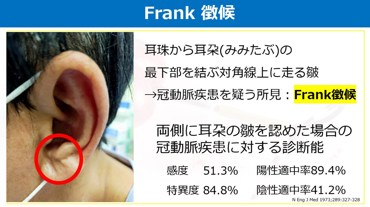 動脈 硬化 耳たぶ 画像