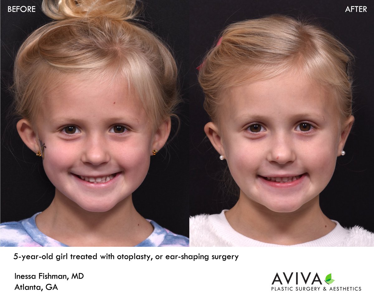 AvivaPSA's tweet photo. #Otoplasty is ear-shaping surgery and a treatment commonly used to treat prominent ears.  Dr. Fishman treats both adults and children with otoplasty, noting this procedure to have high patient satisfaction, especially for patients who have faced teasing about their ears. https://t.co/6i5HfIi0Zp