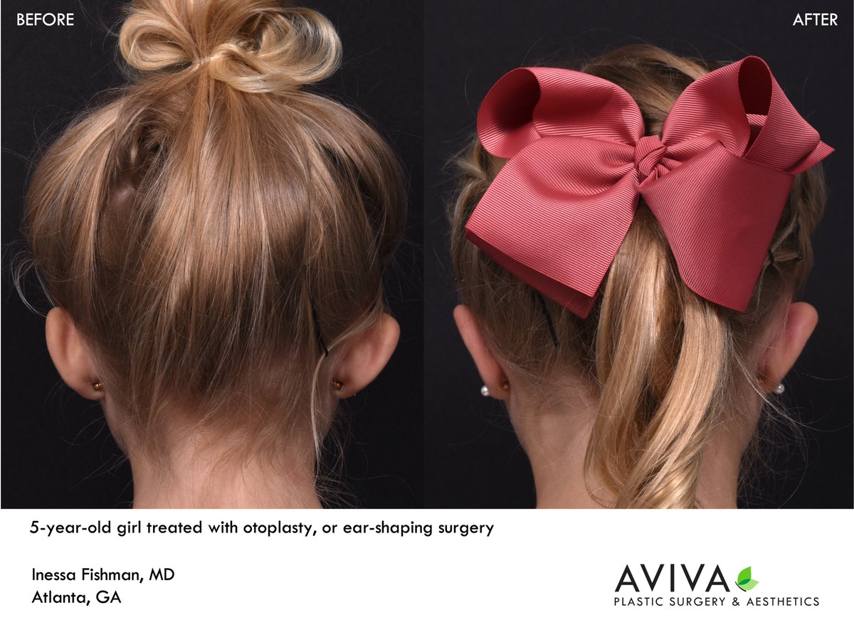 AvivaPSA's tweet photo. #Otoplasty is ear-shaping surgery and a treatment commonly used to treat prominent ears.  Dr. Fishman treats both adults and children with otoplasty, noting this procedure to have high patient satisfaction, especially for patients who have faced teasing about their ears. https://t.co/6i5HfIi0Zp