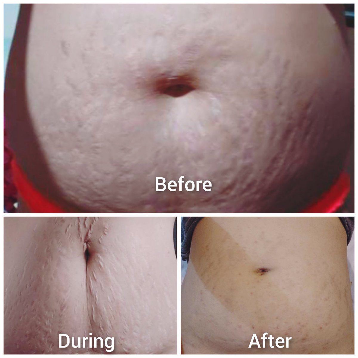 JmieTee's tweet photo. Before, during, &amp; after an intensive parasite cleanse. Lost 10lbs in 1 week (no diet no exercise no effort) + dozens of "stretch marks". How about you? Are you sure your "fat" &amp; "stretchmarks" are real? #stretchmarks #parasitecleanse #weightloss https://t.co/ESLksPWnGg
