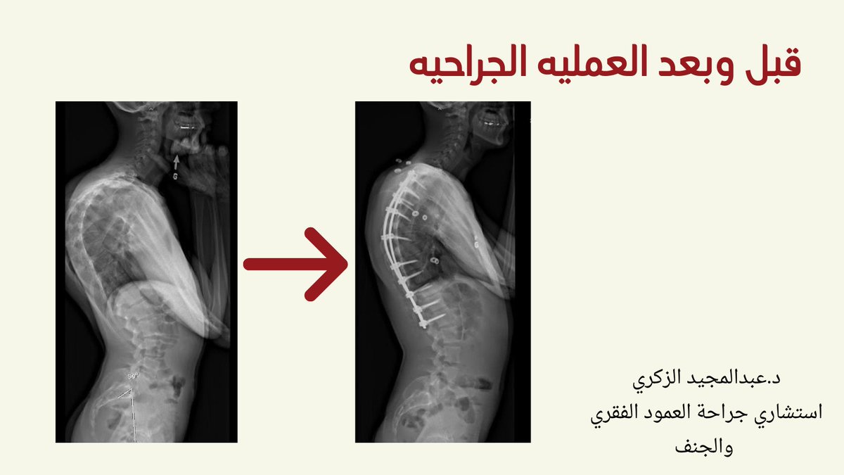 AlzakriA's tweet photo. #الظهر #صحتك #صحتك_حياتك صورة اشعة سينيه في حالة العملية الجراحية لعلاج الحدب https://t.co/zvbbtWzggX