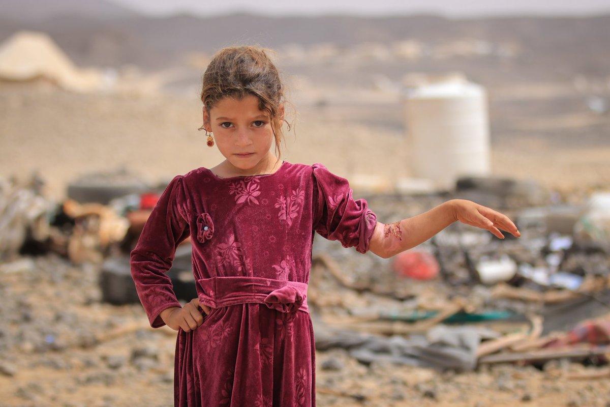 UNHCRYemen's tweet photo. Jana, 8, lives with her mother in a site hosting displaced families in Marib after her dad's death.
She sustained injuries in a fire accident.
On #WorldChildrensDay & on all days, children of #Yemen deserve to live in peace, have a safe home & access to education. https://t.co/fBY1LpOYJb