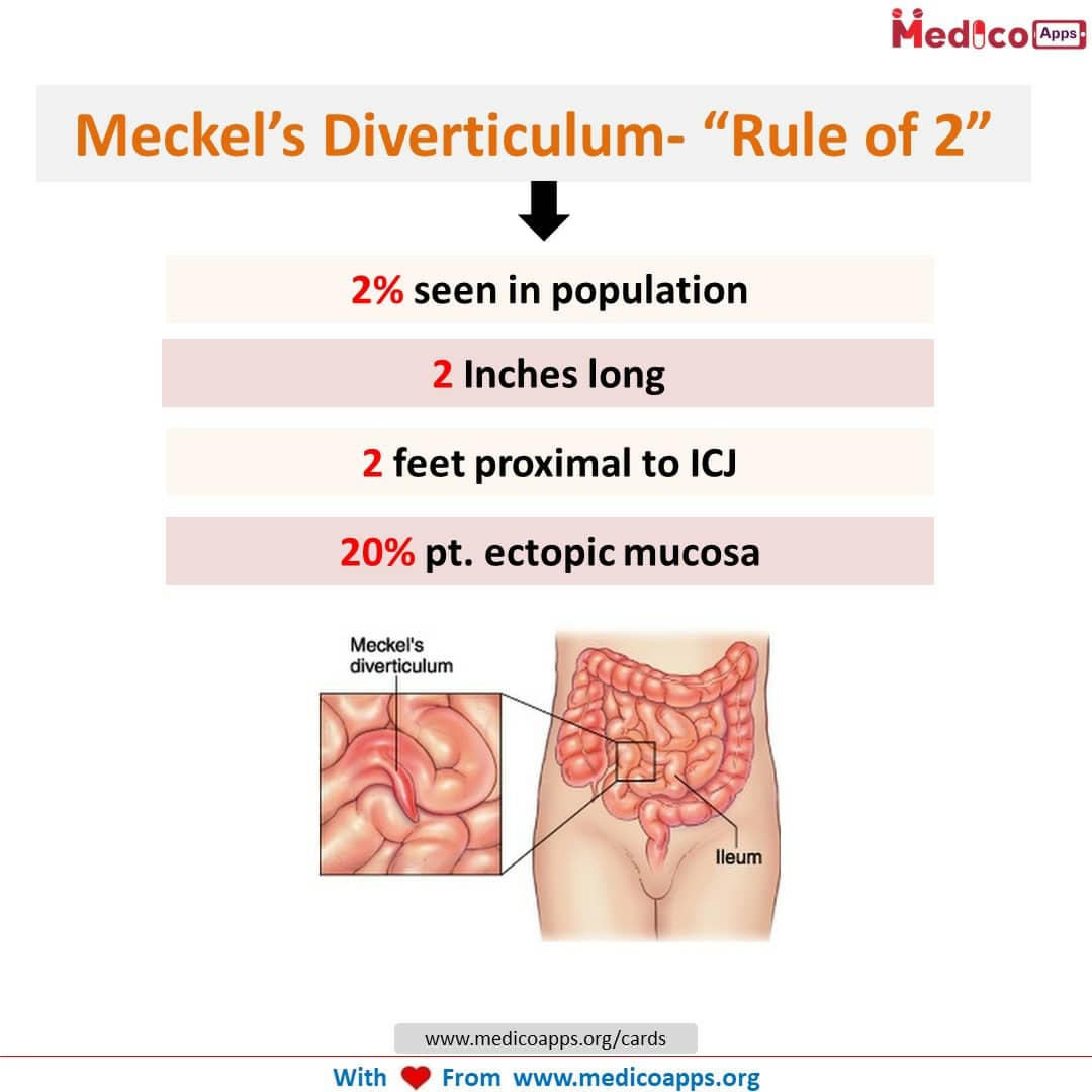Meckel Process Meckels Diverticulum Rule Of 2