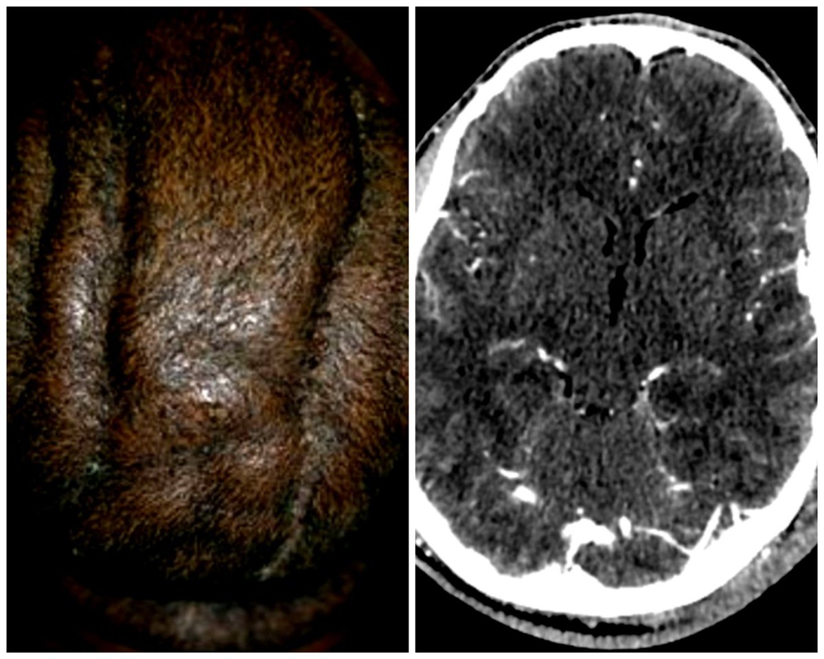 JmieTee's tweet photo. Cutis verticis gyrata - a scalp disorder that thickens the scalp into folds. Cause is currently unknown. Please consider worms as the culprit. Worms burrow through skin, stay for years, &amp; multiply by the thousands. MRI shows worms. @DrKassirNYC
@drkassir @madison_moeller https://t.co/XUbRZGTBfd