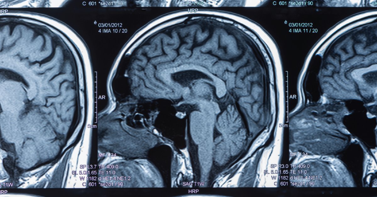WebMD's tweet image. The first human clinical trial of a nasal vaccine to slow the progression of Alzheimer's disease is set to begin after nearly 20 years of research. wb.md/3oAIGTC