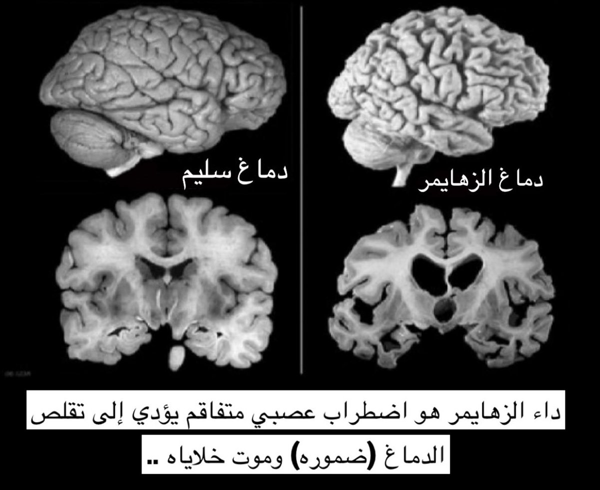 Albanderi_ss's tweet photo. خبر اسعدني جداً 

بعد 20 سنة من الأبحاث .. ستبدأ أول تجربة بشرية للقاح الأنفي لعلاج مرض الزهايمر وللوقاية منه في مستشفى برغام .. 

وممكن يكون جاهز اللقاح في عام 2026 
شكراً للعلم وللعلماء ♥️👏🏻 https://t.co/dw6UjxMu0w