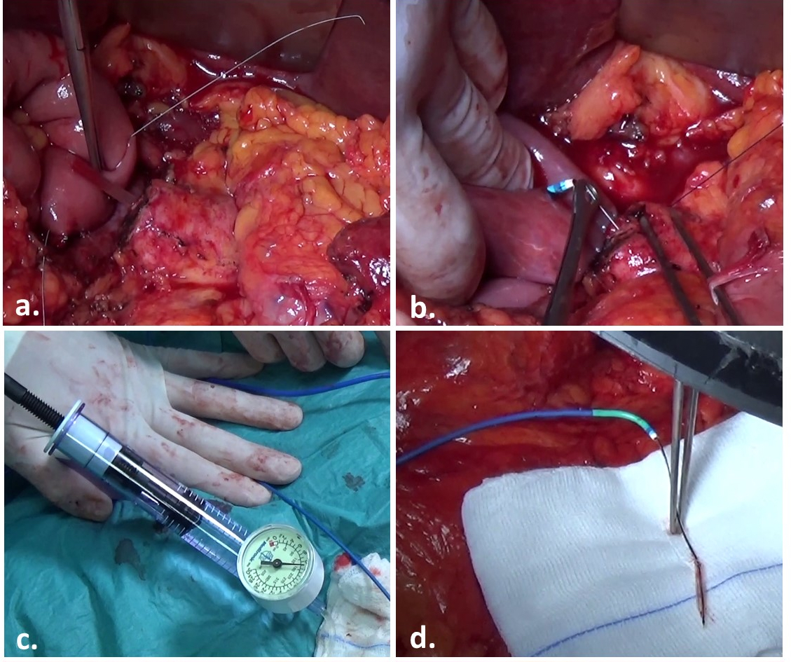Gio_Marchegiani's tweet photo. Coronary Artery Stent 💘 for securing High-risk Pancreatico-jejunal Anastomosis - Pilot Series on @AnnalsofSurgery 

✅ Stent used as a mitigation strategy in 70 pts

0⃣ No displacement of coronary stent vs 20% externalized stents

🆘 Validation needed

https://t.co/exd2dBoSG3 https://t.co/e9a73mZD0a