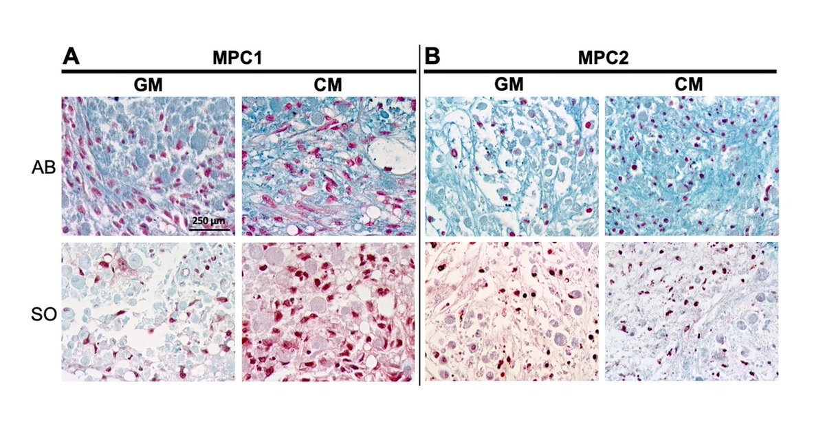MesenchymalCell's tweet image. Collaborators from @IUICMH and @HeSPAuoa, including Dr. Christian Wright (@CSWrightPhD), developed two #mesenchymal progenitor cell lines, both of which were capable of osteogenic, adipogenic, and chondrogenic #differentiation. 🧫

Full article: 📎 go.nature.com/32jzn2Y