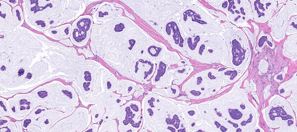 75 yo man w a nodule on the eyebrow. A perfect example of this entity! Reply with your diagnosis then click link to see answer &amp; amazing WSI digital slide of this case: kikoxp.com/posts/3708. #Pathology #dermpath #dermatology #dermatologia #dermtwitter