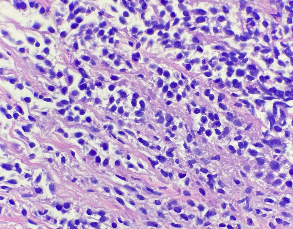 JCloutierMD's tweet photo. A rare sarcoma worthy of sharing. 

Sclerosing epithelioid fibrosarcoma. 

MUC4 IHC shown. 

First described by my mentor Dr. Meis in 1995. Her more recent study of 51 cases emphasizes its potential for aggressive behavior ➡️ https://t.co/LK9fkUR0Ex

#BSTpath #sarcoma https://t.co/sfaZ1hKhxw