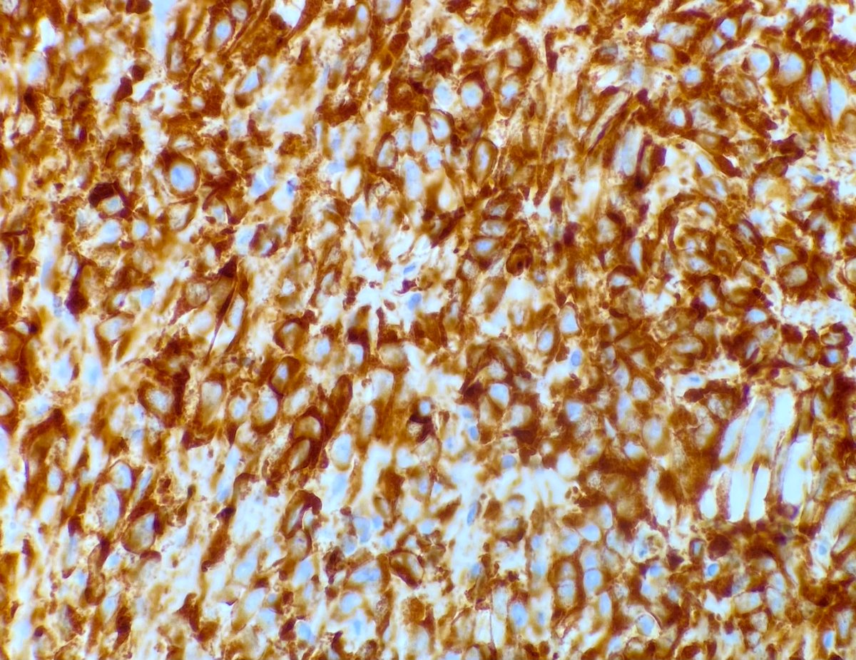 A rare sarcoma worthy of sharing. 

Sclerosing epithelioid fibrosarcoma. 

MUC4 IHC shown. 

First described by my mentor Dr. Meis in 1995. Her more recent study of 51 cases emphasizes its potential for aggressive behavior ➡️ journals.lww.com/ajsp/Fulltext/…

#BSTpath #sarcoma