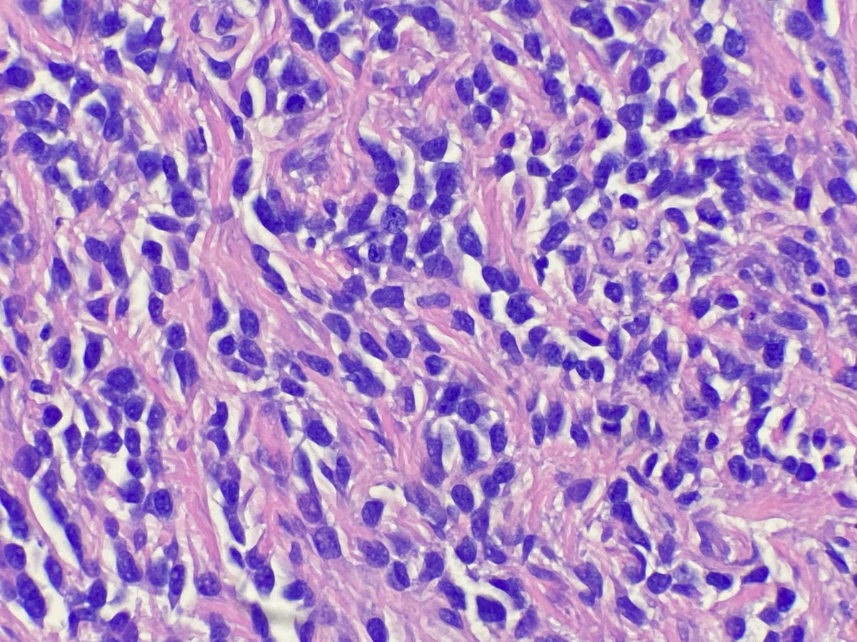 JCloutierMD's tweet photo. A rare sarcoma worthy of sharing. 

Sclerosing epithelioid fibrosarcoma. 

MUC4 IHC shown. 

First described by my mentor Dr. Meis in 1995. Her more recent study of 51 cases emphasizes its potential for aggressive behavior ➡️ https://t.co/LK9fkUR0Ex

#BSTpath #sarcoma https://t.co/sfaZ1hKhxw