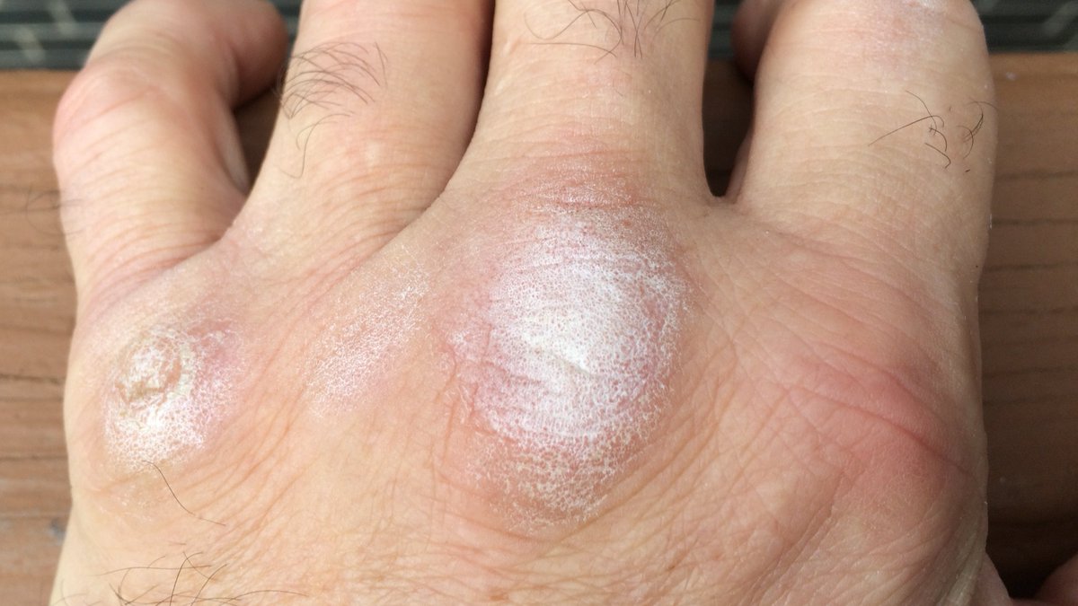 mpetrus19's tweet photo. It's not a bicep picture but 40+ yrs of #handtraining Not for everyone but maybe its for you. Either way whatever you do #KeepGoing nothing happens overnight. #Grit

 #Ironhand #IronFist #KungFu #martialarts #ironfist #bareknuckle 
#disciplineequalsfreedom #dothework https://t.co/ZVR5RHClOU