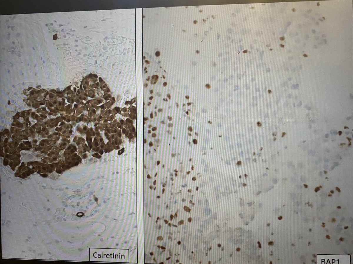 Case 7: 52-year-old female with numerous abdominal adhesions and carcinomatosis #NJSPFall2021