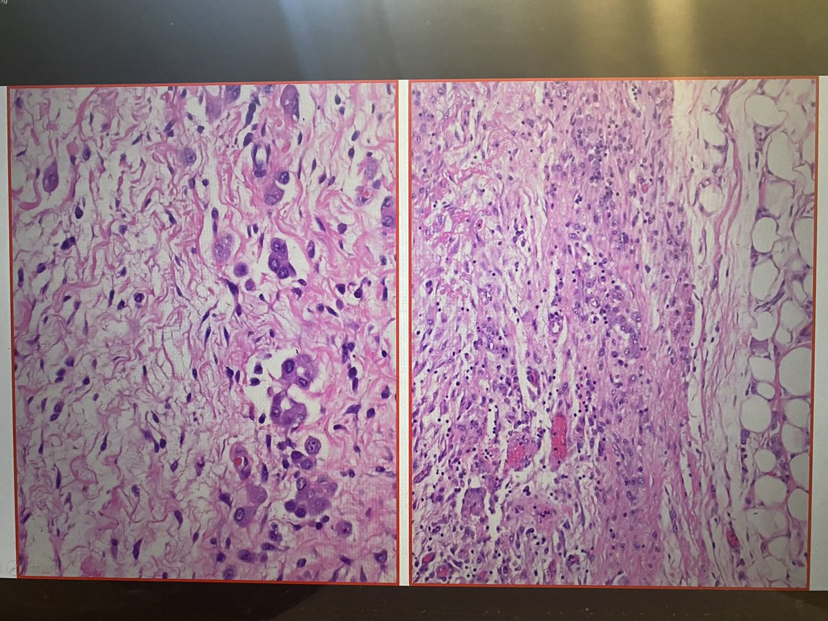 BAP1 loss is lost most commonly in mesothelioma! Small intestine resection also showed mesothelioma. Same patient. #NJSPFall2021