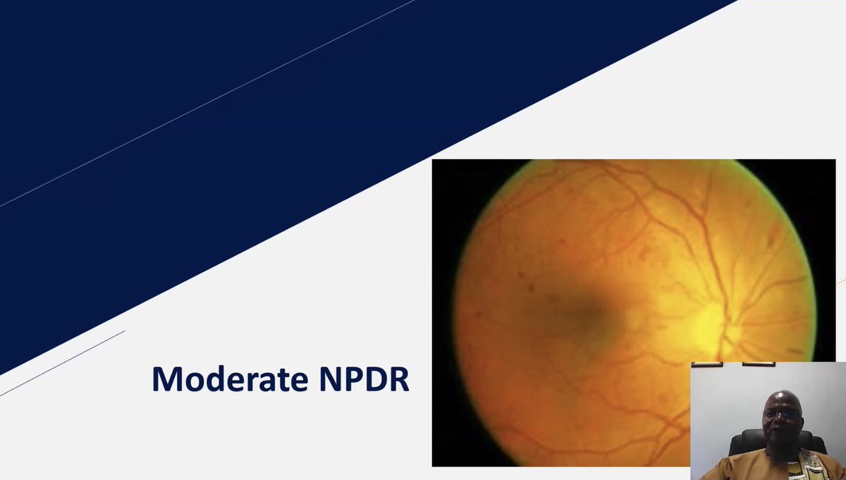 karensparrow's tweet image. Still going strong 💪… last session of the day for me, before Eyes Around the World swings into the Americas. Dr. Raymond Mabaso @ULvarsity @mySAOA reinforcing #Optometrist role in #diabetes. 
 @WorldCouncilOpt #OptometryCE #CET #Optometrist #EyeHealth #EyesOnTheWorld #Learning