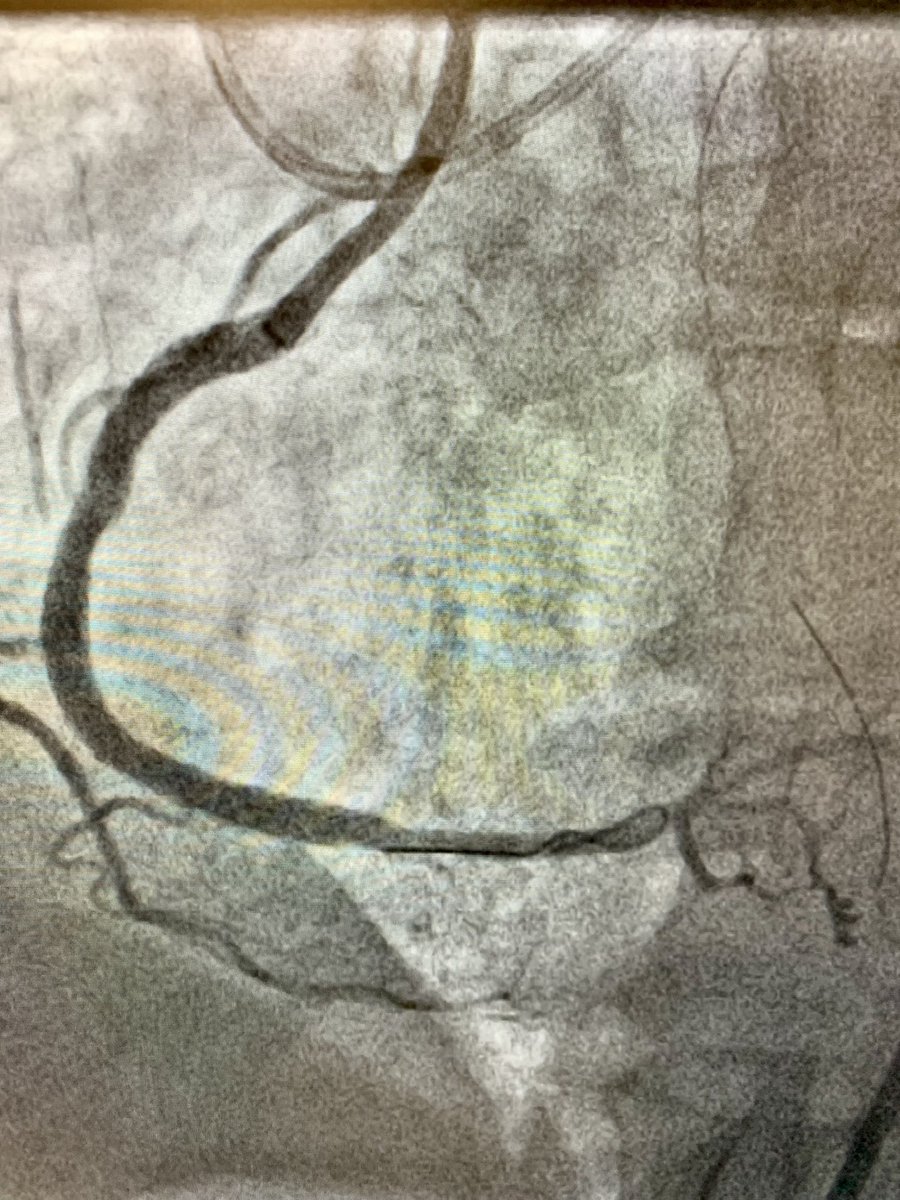 ReVascMed (@revascmed) on Twitter photo Fun Friday with multivessel PCI using pLVAD support after CABG turndown and another PCI CTO at #PennsyInterventions with <a href="/jcgeorgemd/">Jon George</a> <a href="/GPAngioClub/">Phila Angio Club</a> <a href="/PennCVFellows/">Penn Cardiology Fellows</a> Fun Friday with multivessel PCI using pLVAD support after CABG turndown and another PCI CTO at #PennsyInterventions with <a href="/jcgeorgemd/">Jon George</a> <a href="/GPAngioClub/">Phila Angio Club</a> <a href="/PennCVFellows/">Penn Cardiology Fellows</a>