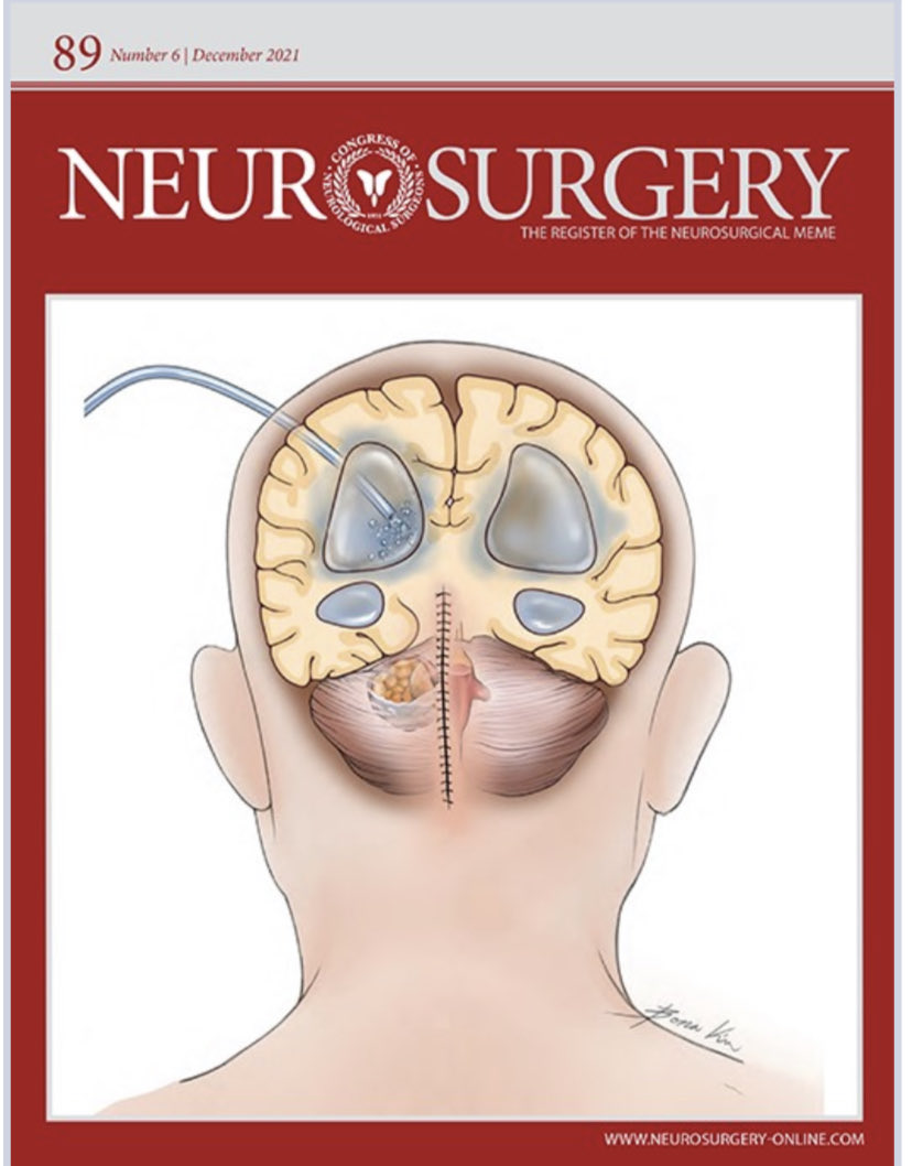 AliAlawiehmdphd's tweet photo. Strong work #CTORE (CNS Tumor Outcome Registry at Emory) making the cover of this issue @NeurosurgeryCNS on predictors of permanent CSF diversion in adult posterior fossa tumors @KimberlyBHoang @EmoryNeurosurg @AANSNeurosurg @EmoryBrain https://t.co/NOJBhY8hxa