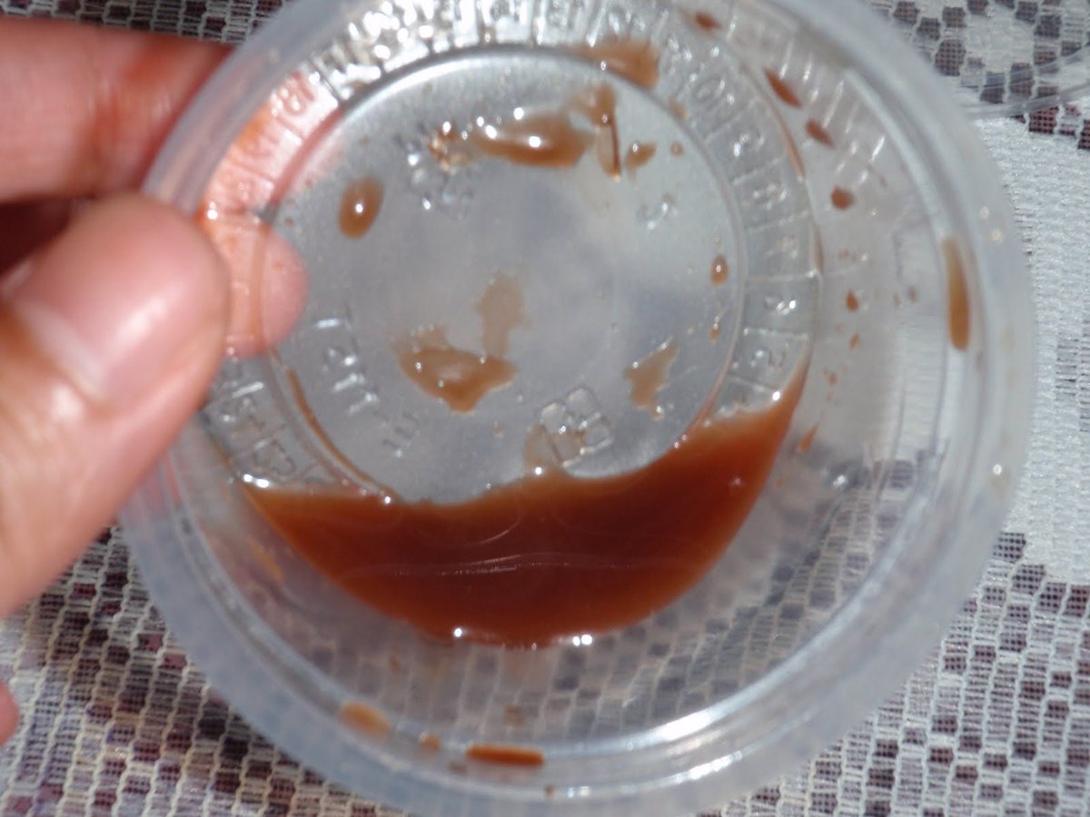 Эпителиальные клетки в молочной железе. Желто зеленые выделения. Обильные слизистые выделения с запахом. Выделения из молочных желез. При фиброзно кистозной мастопатии.