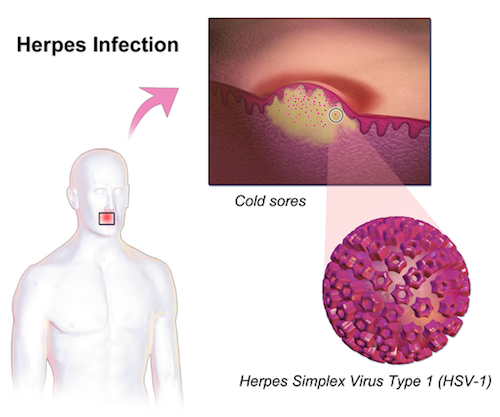lswn2000's tweet photo. [ARTICOLO, SALUTE]
Un gruppo di scienziati USA ritiene di aver compreso in che modo il virus dell’Herpes riesce a violare il nostro sistema nervoso.
Approfondisci 👉 https://t.co/3gKk5qkJEP https://t.co/LuEMLp4eBS