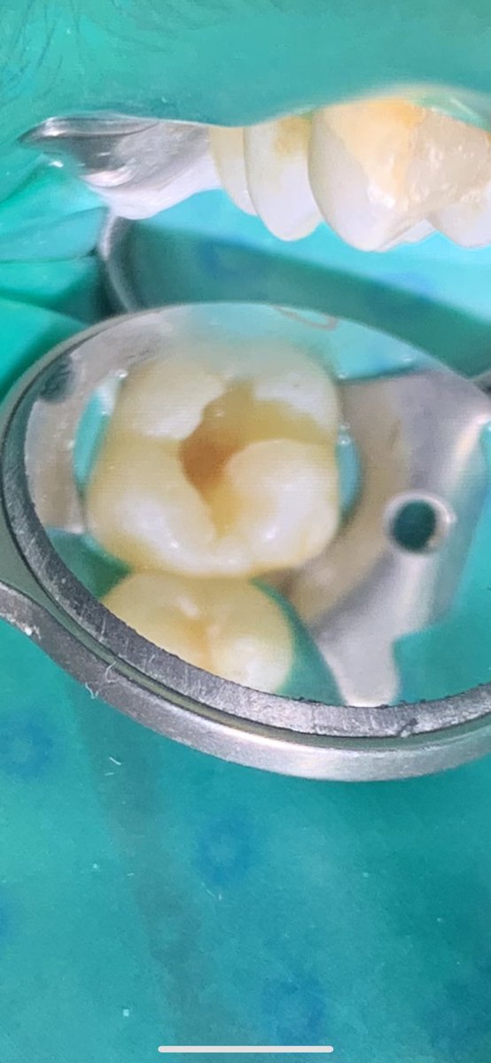 MFDent's tweet photo. Today's simple procedure

#16 Class I OP deep caries 

عالرايق https://t.co/eMCLfPNexx