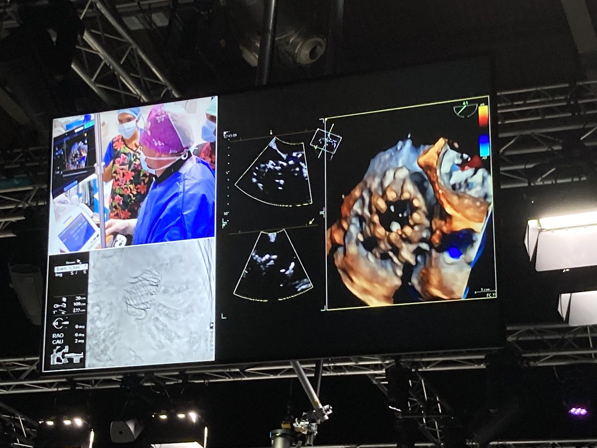 Terrific #treatTR case: step-by-step  #evoque from @Edwards_TAVR #PCRTricuspid with @didier_tchetche @nicolasdumonte1 and great discussion w/ @azeemlatib Future looks bright for TR at #PCRLV @Sticchi_Alex  @CurioJonathan