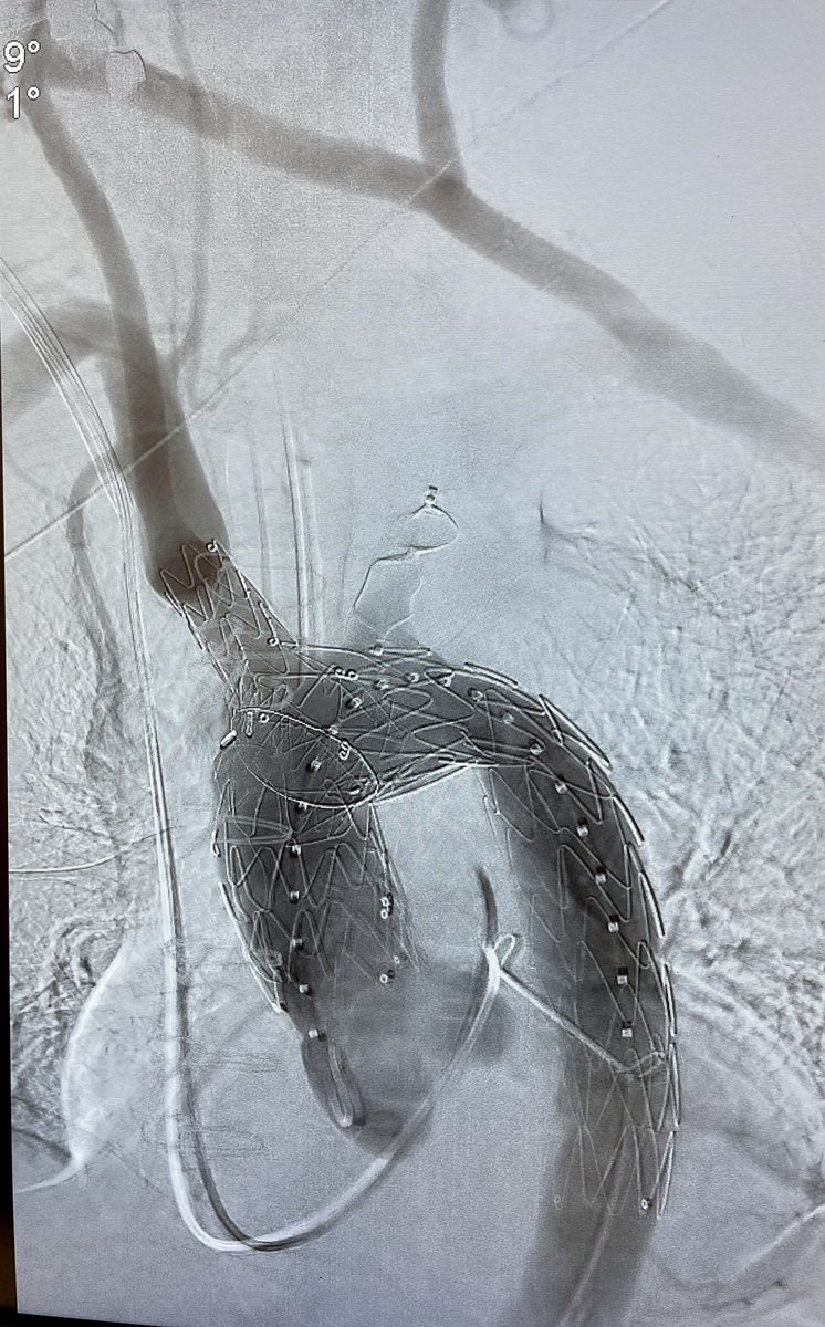 malas_mahmoud's tweet photo. First Nexus case @EndospanLtd in the west coast @UCSDsurgery Rt carotid to lt subclavian bypass and lt carotid transposition to graft. Cutting edge solutions for all aortic pathologies from Ao valve to iliacs @UCSDHealth Great collaboration with cardiac surgery https://t.co/N9D4DNhV6N