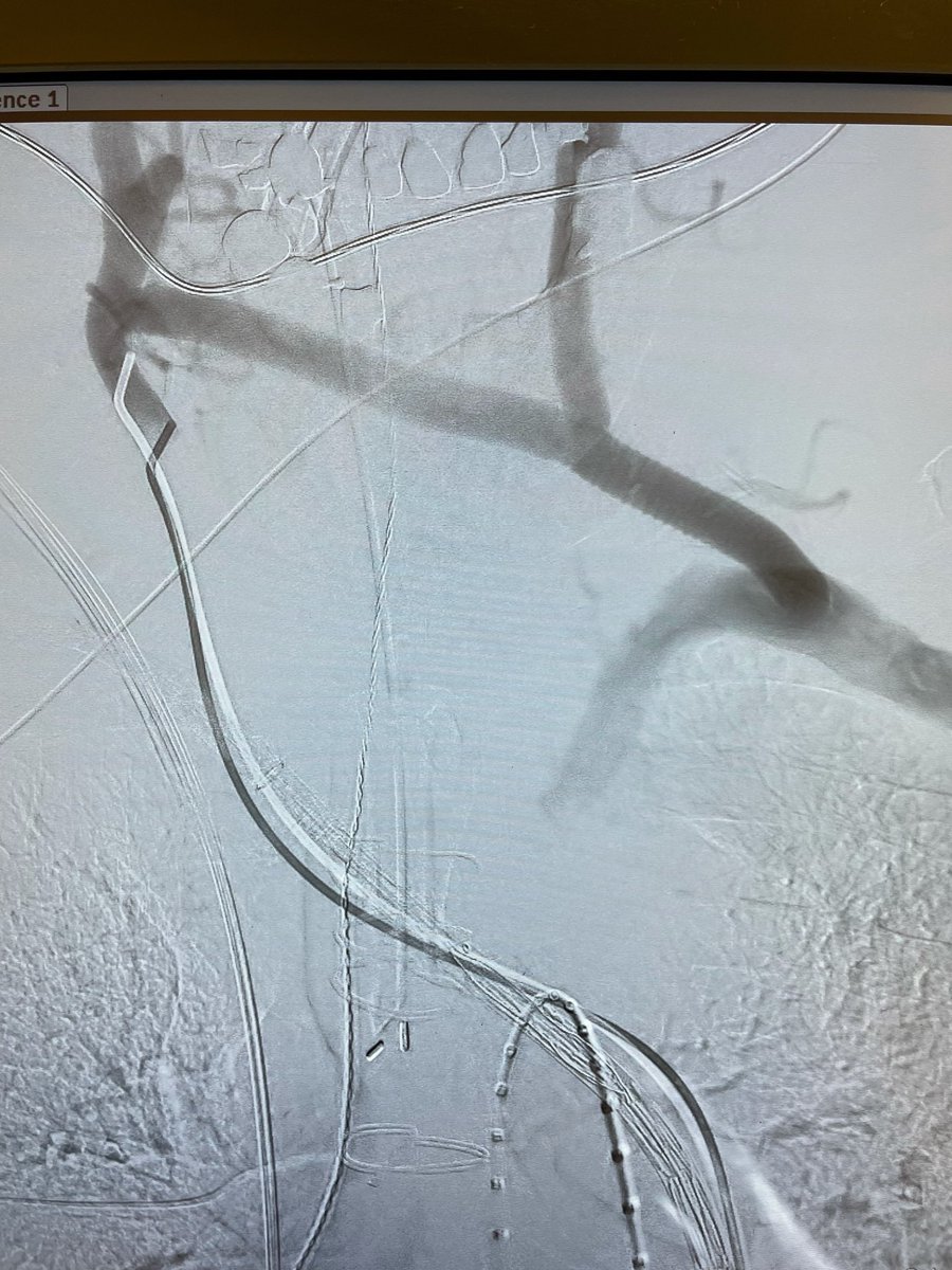 Mahmoud Malas,MD,MHS (@malas_mahmoud) on Twitter photo First Nexus case <a href="/EndospanLtd/">Endospan</a> in the west coast <a href="/UCSDsurgery/">UC San Diego Surgery</a> Rt carotid to lt subclavian bypass and lt carotid transposition to graft. Cutting edge solutions for all aortic pathologies from Ao valve to iliacs <a href="/UCSDHealth/">UC San Diego Health</a> Great collaboration with cardiac surgery First Nexus case <a href="/EndospanLtd/">Endospan</a> in the west coast <a href="/UCSDsurgery/">UC San Diego Surgery</a> Rt carotid to lt subclavian bypass and lt carotid transposition to graft. Cutting edge solutions for all aortic pathologies from Ao valve to iliacs <a href="/UCSDHealth/">UC San Diego Health</a> Great collaboration with cardiac surgery