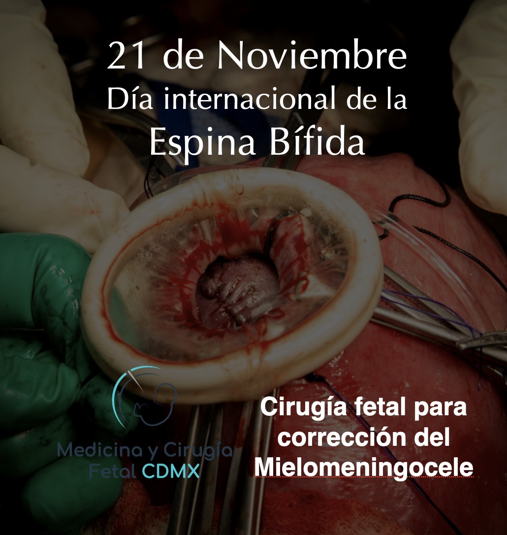 Hoy conmemoramos el Día Internacional de la Espina Bífida, ¡nunca como antes hemos podido hacer tanto por estos bebés! #mielomeningocelefetal #fetalsurgery, 
youtu.be/D9cV7tq9i-0