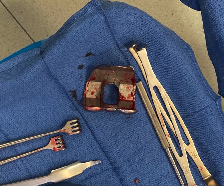 patejareds's tweet photo. @NaanDerthaal @generalorthomd @CenterRotation @BrianChalmersMD @Dr_Stambough @kate_wynne @ACR_MD @DrAntoniaChen @denehy1 Exactech femur taken out. Literally no cement on component. To be fair also in setting of chronic infection. Never saw this before as I use mostly Stryker https://t.co/9fPSJrHdVq
